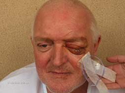 British tourist could lose sight in one eye after defending a woman in a bar